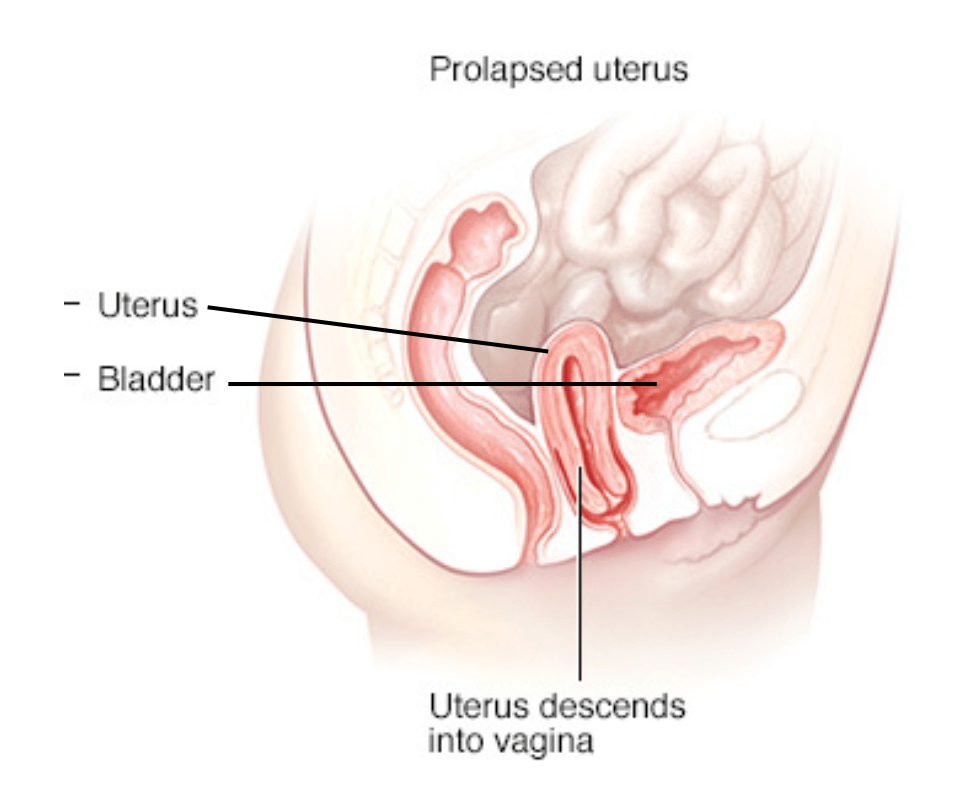 pelvic-floor-dysfunction-cystocele-prolapse